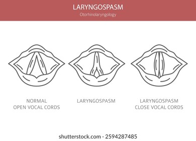 Laryngospasm diseases. Otorhinolaryngology. Vocal cord disfunction. Medical infographic design. Vector illustration