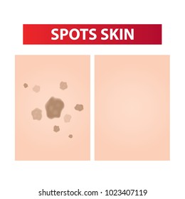 Laser For Clear Of Dark Spots Step Vector Illustration