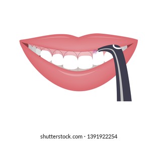 Corrección láser de alta sonrisa o sonrisa chicle. Ilustración vectorial. Antes y después