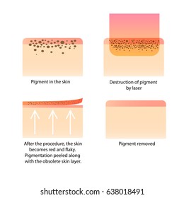 Laser cosmetology. Procedure for removing tattoo, freckles, old dark spots pigment