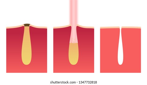 laser cure acne อำแะนพ