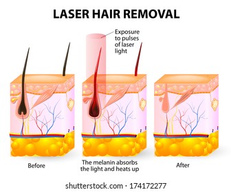 laser emits an invisible light which penetrates the skin without damaging it. At the hair follicle, the laser light absorbed by the pigments is converted into heat. This heat will damage the follicle.