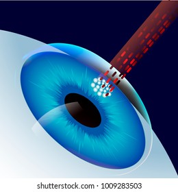 Laser Eye Correction  vector illustration icon symbol