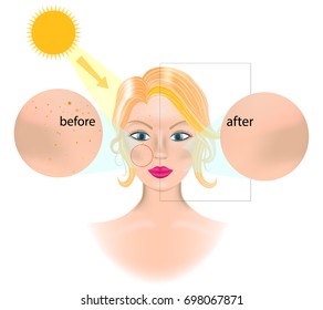 Laser Freckle Removal . Vector illustration - Why do freckles come out in the sun? Concept for whiten skin and remove freckles, dark spots and sunspots.
