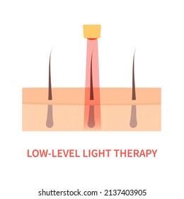 Estimulación del crecimiento del cabello láser. Tratamiento de la luz roja para la restauración del cabello en alopecia androgenética. Concepto médico. Ilustración vectorial.