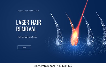 Laser hair removal concept in polygonal futuristic style for landing page. Vector illustration of a hair follicle with a laser to demonstrate the removal process  on a blue background