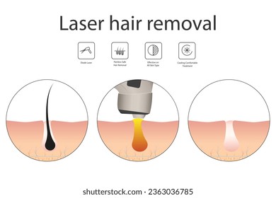 Laser hair removal concept with skin and hair areas. Stages of the removal procedure. Medical diagram before and after using a laser. Vector illustration