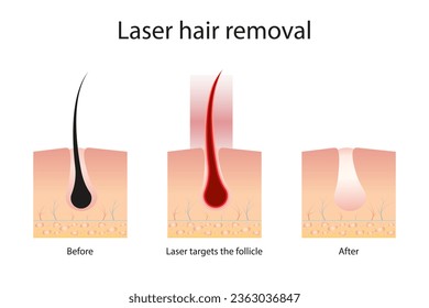 Concepto de depilación láser con área de piel y cabello. Etapas del procedimiento de retirada. Diagrama médico antes y después de usar un láser. Ilustración del vector