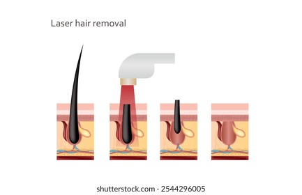 Remoção de cabelo a laser, efeitos do laser no cabelo. Vetor realista