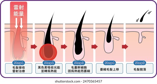 laser hair removal how does laser affect the hair follicle - infographic , flat illustration 