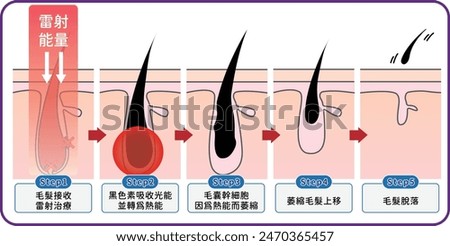 laser hair removal how does laser affect the hair follicle - infographic , flat illustration 