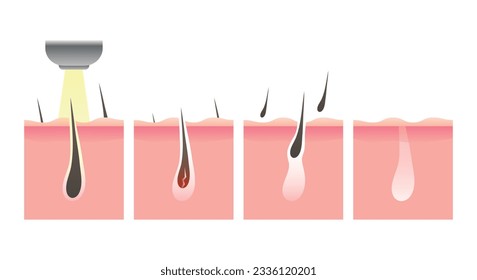 Ilustración de depilación láser. Ipl paso del icono de eliminación del folículo capilar. Antes y después de usar el láser. Proceso de depilación por láser. Ilustración del vector