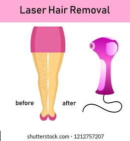 laser hair removal, legs of girl and a laser apparatus, vector illustration