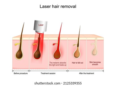 Laser hair removal. The melanin absorbs the light and heats up, Hair to fall out. Vector diagram about skin and hair condition Before procedure, After the treatment and during Treatment session.