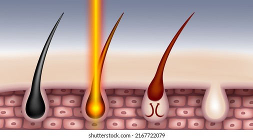 Laser Haarentfernung nach Erhalt Laser Licht Haare brennt und fällt ab, was die beste Möglichkeit, Haare zu entfernen. EPS Realistische Datei.