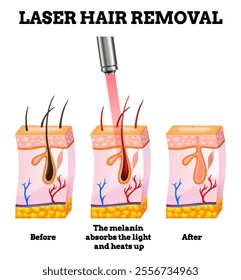 Laser hair removal procedure with concentrated beam of light on the skin. Skin layers, laser affects on body hair. Face hair removal icon for cosmetology or skincare. Medical science concept
