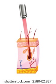 Laser hair removal procedure with concentrated beam of light on the skin. Skin layers, laser affects on body hair. Face hair removal icon for cosmetology or skincare. Medical science concept