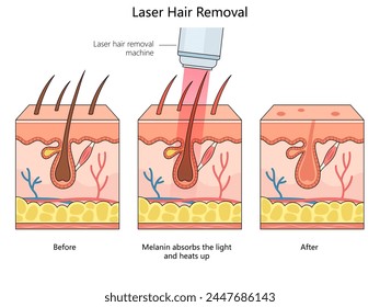 Depilación láser, que muestra la piel antes, durante y después del diagrama de estructura del procedimiento dibujado a mano Ilustración vectorial esquemática. Ilustración educativa de ciencias médicas