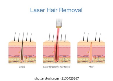 Laser hair removal at the skin layer and follicle for beauty and smoothness. Medical diagram before and after use laser get rid hair.