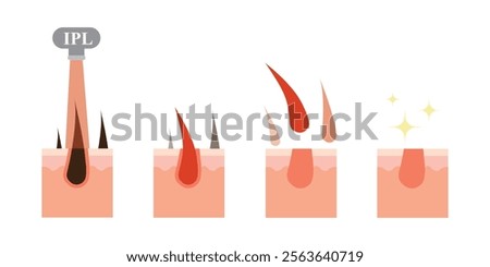 Laser hair removal steps. Process of laser epilation infographic. Human skin and hair follicles. Vector illustration isolated on white.