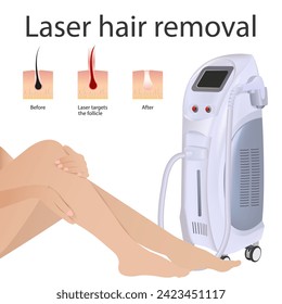 Laser hair removal of women's legs. Modern equipment for laser hair removal cosmetic procedures in a beauty salon