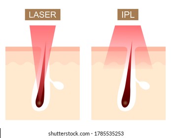 Laser And IPL Hair Removal Illustration. Hair Skin Structure. Isolated On White Background