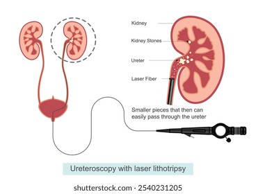 Laser lithotripsy is a procedure providers use to break up and remove stones.During this procedure a laser beam is applied directly to the stone to break it into small pieces and passed easily.medical