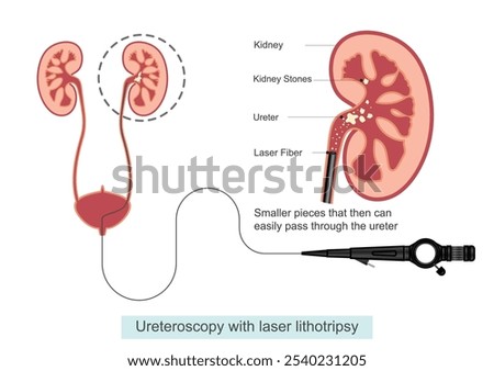 Laser lithotripsy is a procedure providers use to break up and remove stones.During this procedure a laser beam is applied directly to the stone to break it into small pieces and passed easily.medical