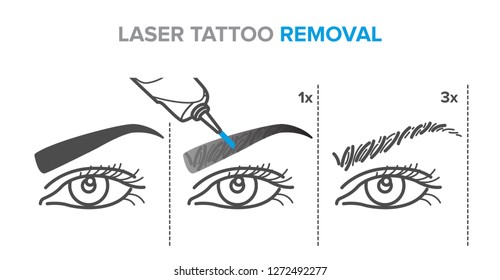 Laser-dauerhafte Make-up-Entnahmestufen, Augenbrauenentfernung Tätowierungsverfahren. Illustration für Ihr Design