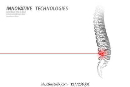 Laser Physiotherapy Human Spine Injury. Pain Area Surgery Operation Modern Loin Medicine Technology Low Poly Triangles 3D Render Female Back Hernia Vector Illustration