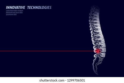 Laser Physiotherapy Human Spine Injury. Pain Area Surgery Operation Modern Loin Medicine Technology Low Poly Triangles 3D Render Female Back Hernia Vector Illustration