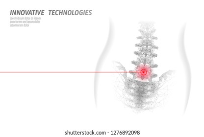 Laser Physiotherapy Human Spine. Pain Area Surgery Operation Modern Medicine Technology Low Poly Triangles 3D Render Female Back Hernia Vector Illustration