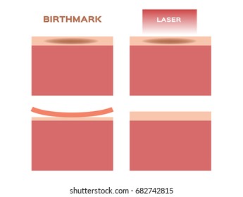 laser remove the birthmark vector