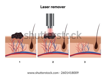 Laser remover of different types of skin lesions papillon, birthmark, mole, melanoma, keratome, hemangioma