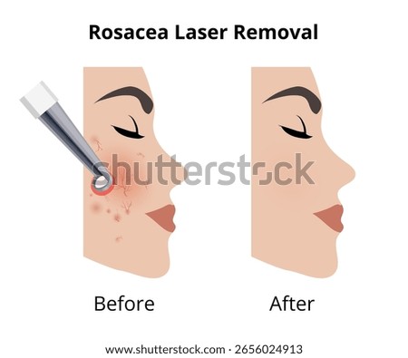 Laser removing rosacea couperose on woman face before and after procedure