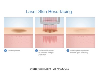 Laser skin resurfacing in 3 Step3. Skin with dark spots, freckles and scar on surface faded after treating with laser energy deep in the skin layer.