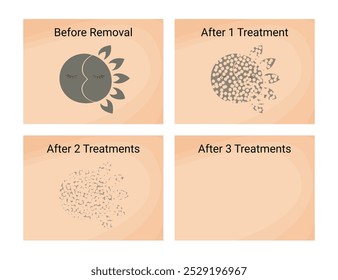 Procedimiento de eliminación de tatuajes con láser antes y después