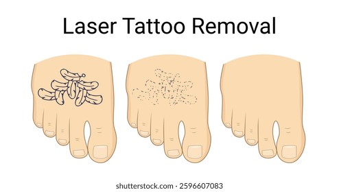 Laser Tattoo Removal Procedure on foot