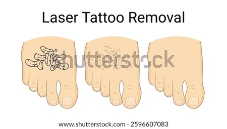 Laser Tattoo Removal Procedure on foot