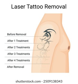 Pasos del procedimiento de eliminación de tatuajes con láser