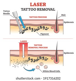 Laser Tattoo Removal Process Labeled Educational Explanation Outline Concept. Anatomical Epidermis Side View With Pigment Under Skin Vector Illustration. Professional Cosmetic Procedure To Erase Ink.