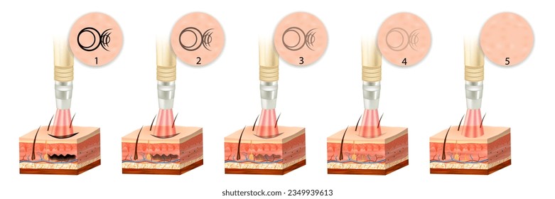 Eliminación del tatuaje láser en capas de piel antes y después. La tinta oscura absorbe la luz y se descompone.