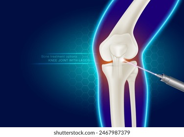 Laser treatment of knee joints Modern medical technology for treating joint injuries Reduce injuries and joint pain. Realistic vector illustration.