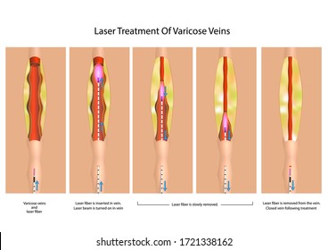 Laser Treatment Of Varicose Veins