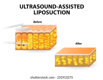 laser and ultrasound assisted liposuction procedures. Ultrasonic breaks down fat cells within the body.