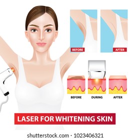 Laser Whitening Armpit Before After Vector Stock Vector Royalty Free Shutterstock