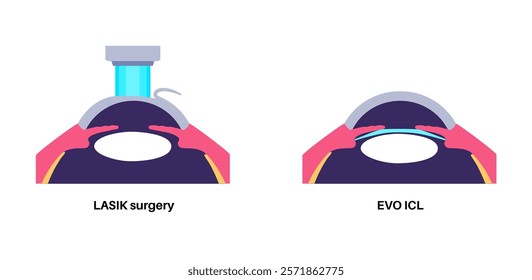 LASIK and EVO ICL eye surgery. Correction of vision diseases. Nearsightedness, farsightedness, astigmatism treatment with laser or lens implantation. Safe painless procedure human eye medical vector