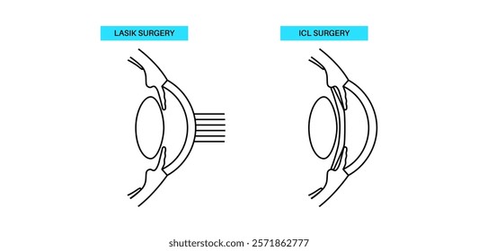 LASIK and EVO ICL eye surgery. Correction of vision diseases. Nearsightedness, farsightedness, astigmatism treatment with laser or lens implantation. Safe painless procedure human eye medical vector