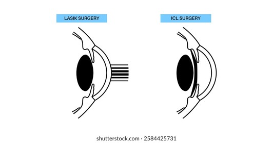 LASIK and EVO ICL eye surgery. Correction of vision diseases. Nearsightedness, farsightedness, astigmatism treatment with laser or lens implantation. Safe painless procedure human eye medical vector