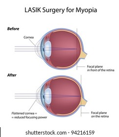 Lasik Eye Surgery For Myopia